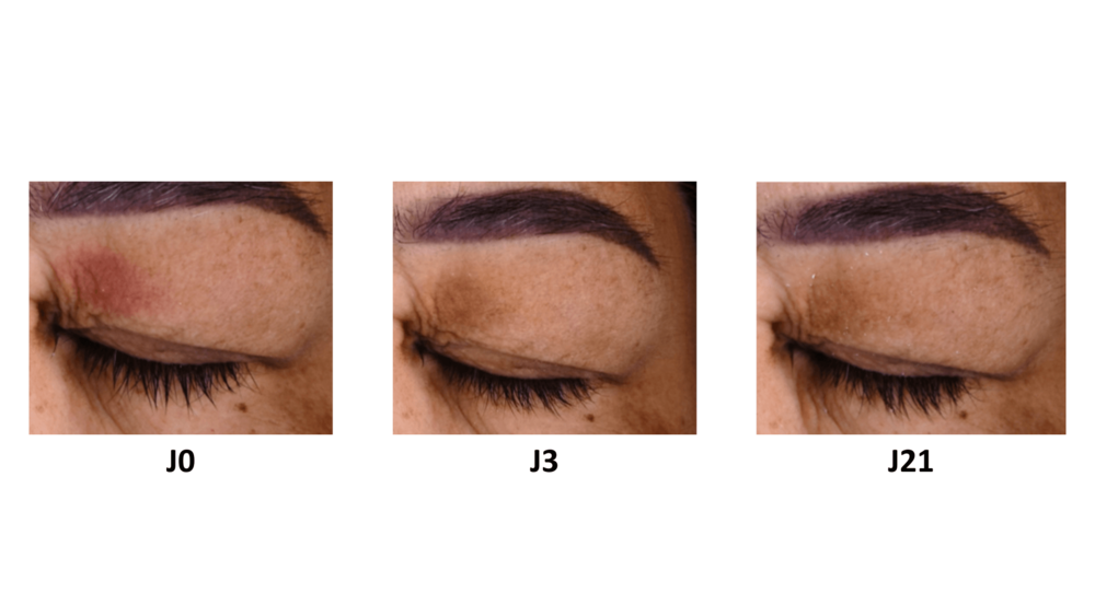 Avant/Après PALPEBRAL