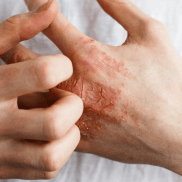 du_dexyane_eczema_silo_l3_header_eczema-hand