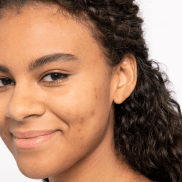 du_melascreen_silo_hyperpigmentation_causes_l3_hormonal brown spots