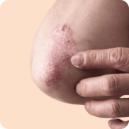 Psoriasis