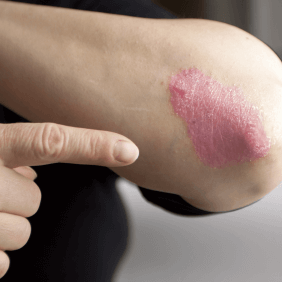 Comment soulager les démangeaisons causées par votre psoriasis en plaque ?