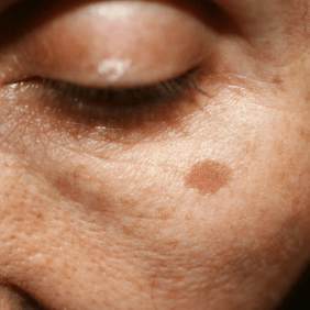 du_article_brown-spots_body2