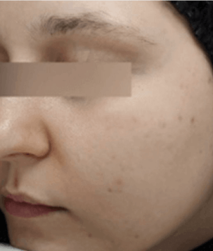 Après, Keracnyl sérum