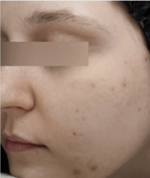 Avant, Keracnyl sérum