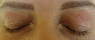 Paupières Jour 1