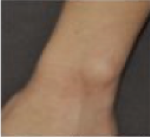 Application de la crème barrière : J8