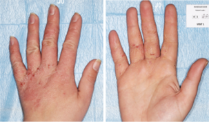 Application de Dexyane MeD crème : Jour 1