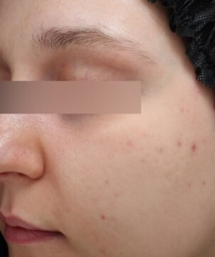KERACNYL SERUM - PICTURE AFTER 1 MONTH