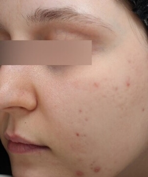 KERACNYL SERUM - PICTURE BEFORE