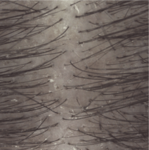 Evolution de plaques de psoriasis sur un cuir chevelu traité en entretien par KERTYOL PSO shampooing : J56