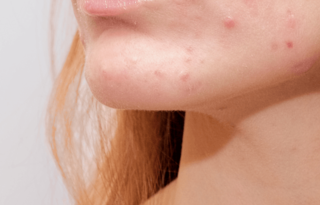 acne
