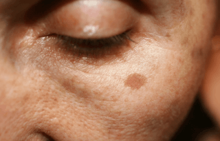 du_article_brown-spots_body2