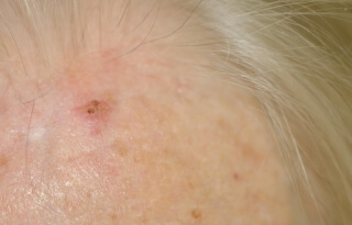 Keratose actinique 3