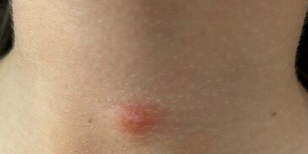 tumeur cervicale