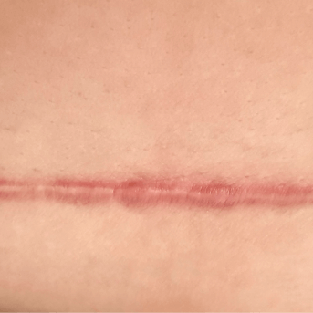 EPITHELIALE ULTRA - CICATRICE